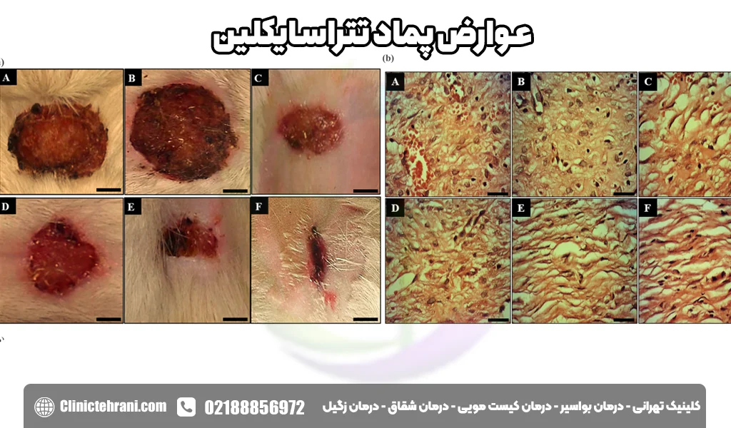 عوارض پماد تتراسایکلین