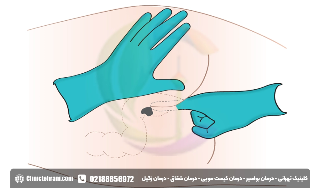 نحوه استفاده شیاف دیکلوفناک