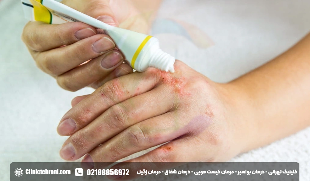 پماد هیدروکورتیزون برای قارچ پوستی