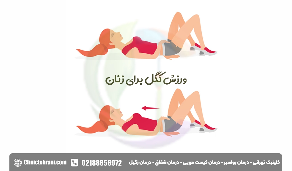 ورزش کگل برای زنان