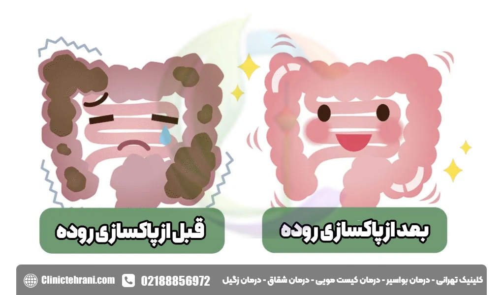 پاکسازی روده یا کولون بزرگ