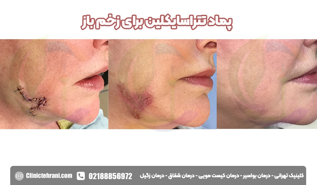 پماد تتراسایکلین برای زخم باز