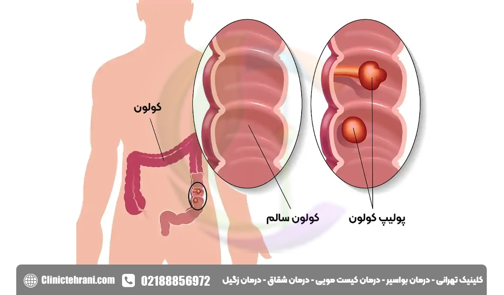آزمایش کولونوسکوپی