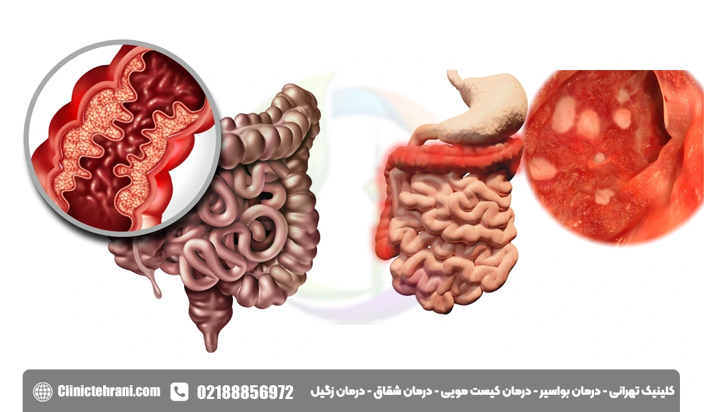التهاب روده