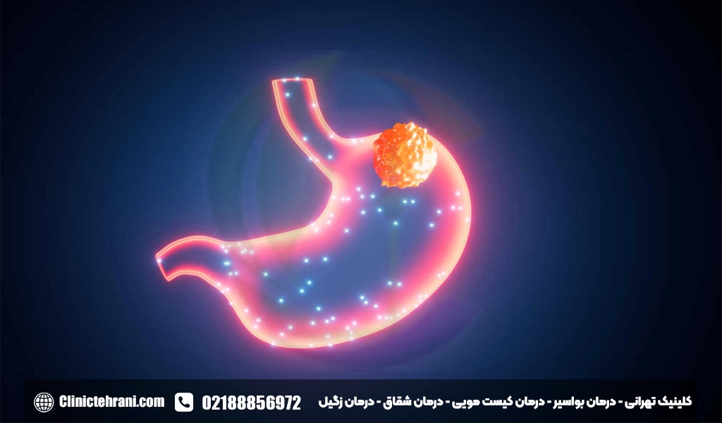 اسید معده چیست