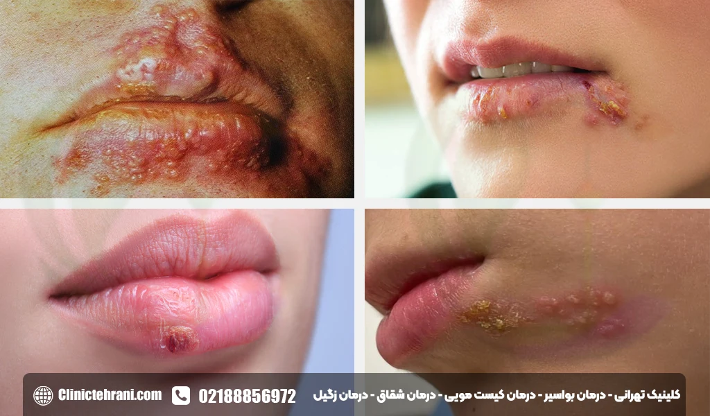 تبخال-تناسلی-در-دهان<img src=