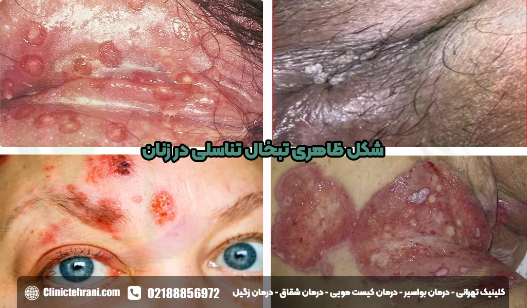 شکل-ظاهری-تبخال-تناسلی-در-زنان<img src=