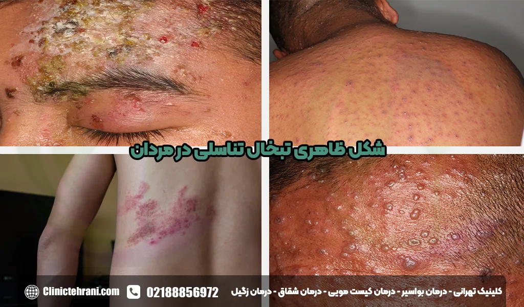 شکل ظاهری تبخال تناسلی در مردان<img src=