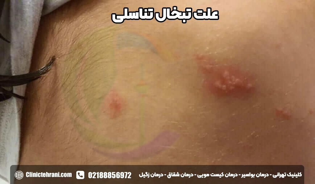 علت تبخال تناسلی<img src=