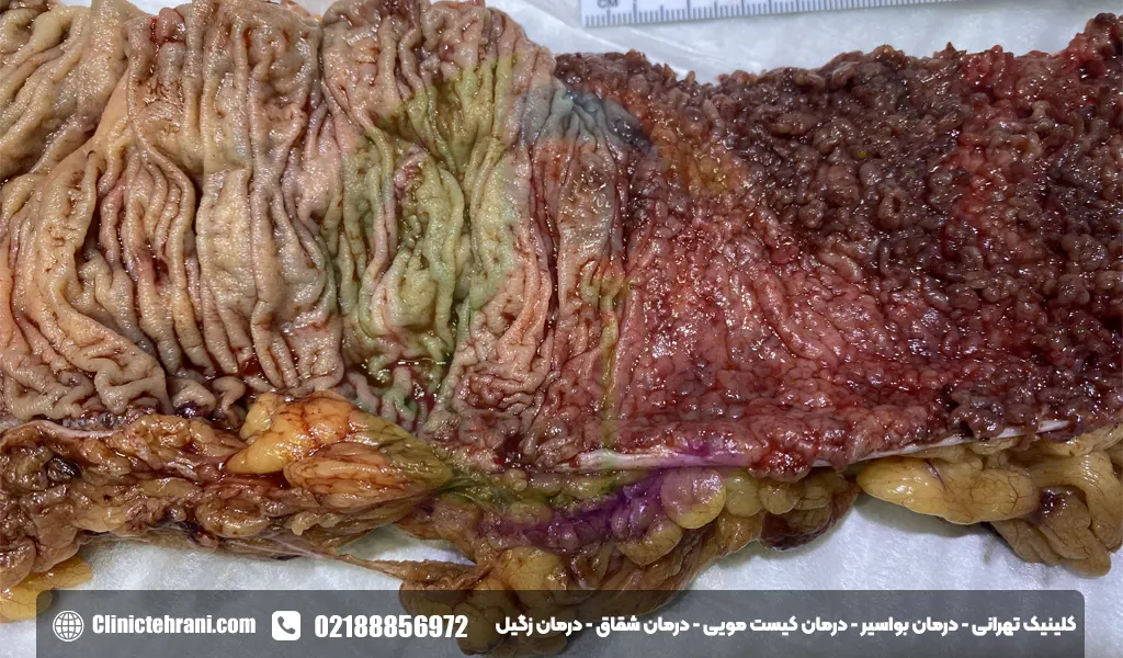 عکس روده ملتهب