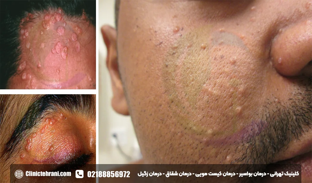 عکس مولوسکوم تناسلی