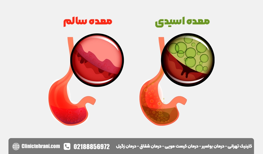 برای اسید معده چه بخوریم