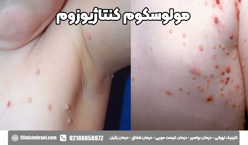مولوسکوم کنتاژیوزوم