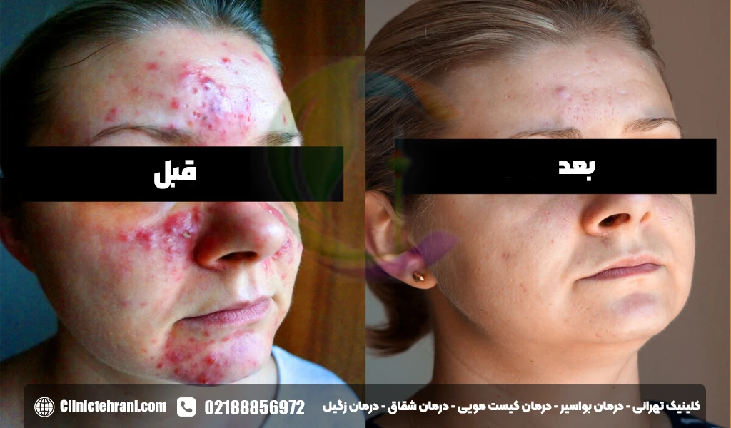 پماد زینک اکساید برای لک صورت