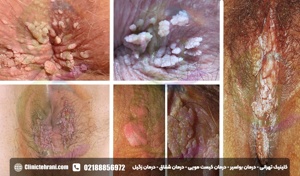 عکس زگیل مقعدی در زنان