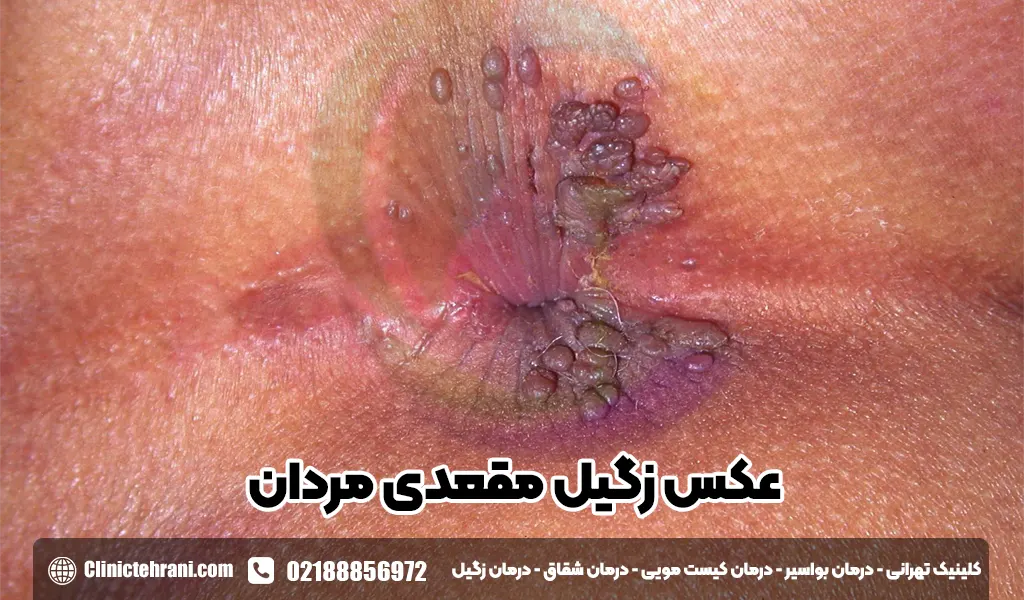 عکس-زگیل-مقعدی-در-مردان