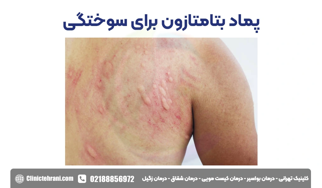 پماد بتامتازون برای سوختگی