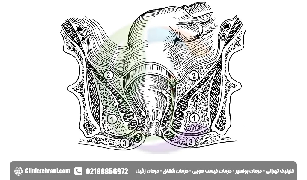 گشاد شدن مقعد