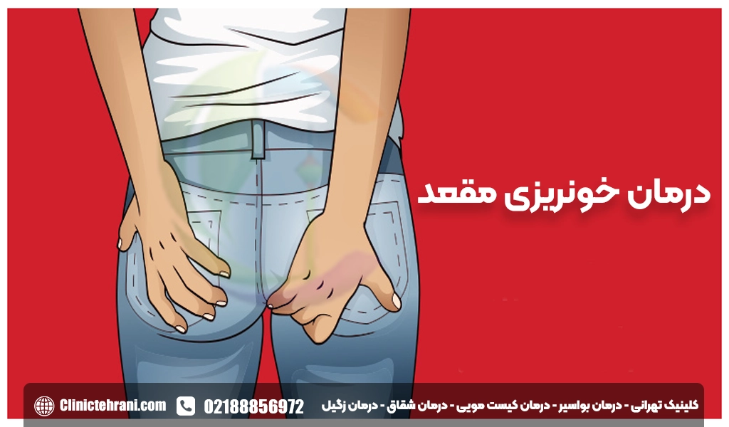 درمان خونریزی مقعد