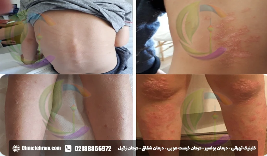 عکس انواع پسوریازیس