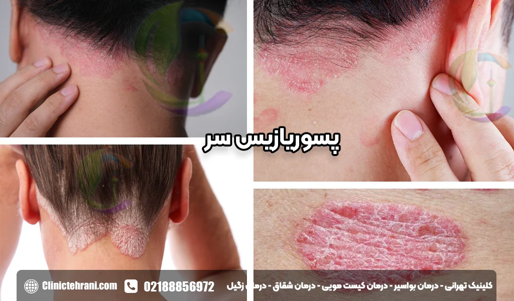 پسوریازیس سر