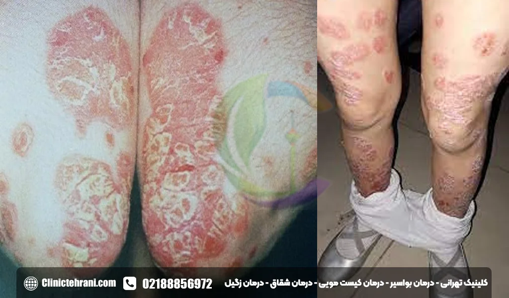 پسوریازیس پا