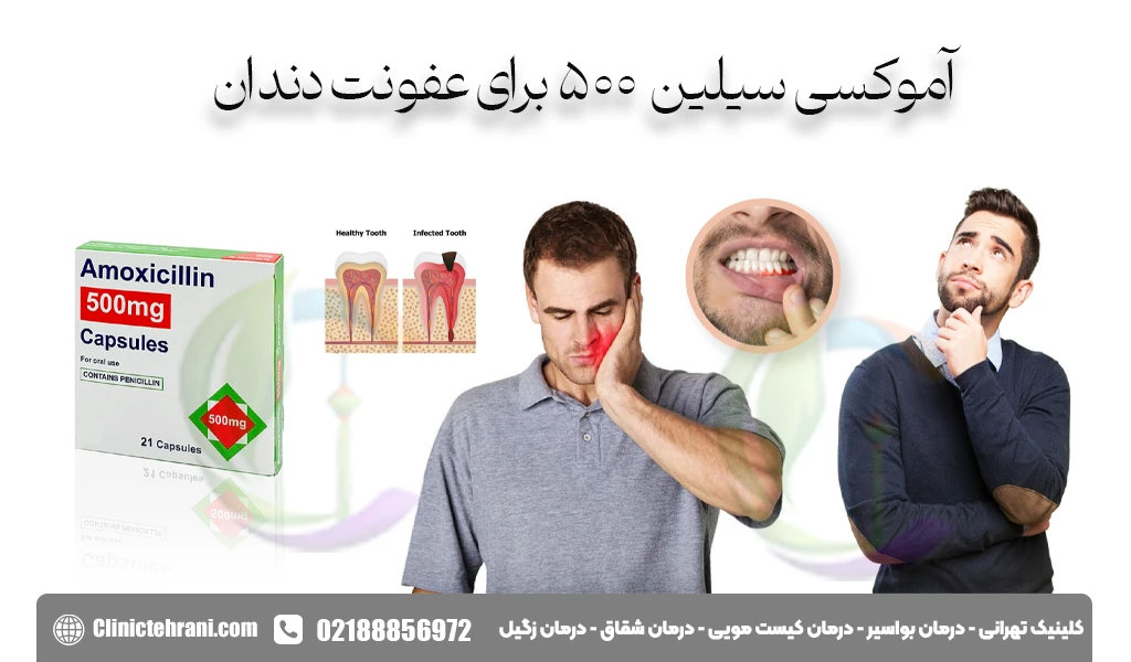 آموکسی سیلین 500 برای عفونت دندان