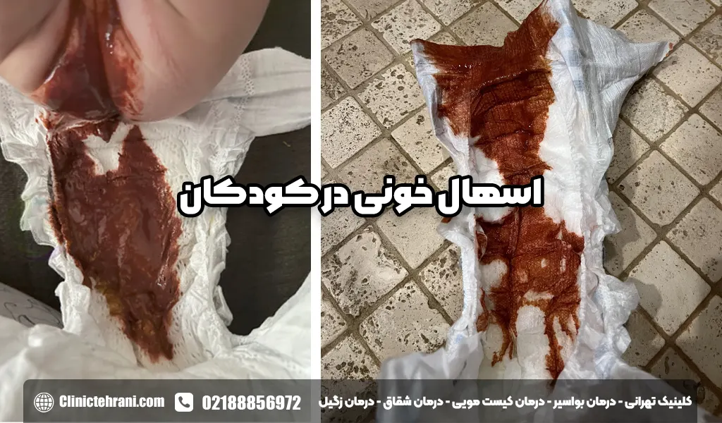 اسهال خونی در کودکان