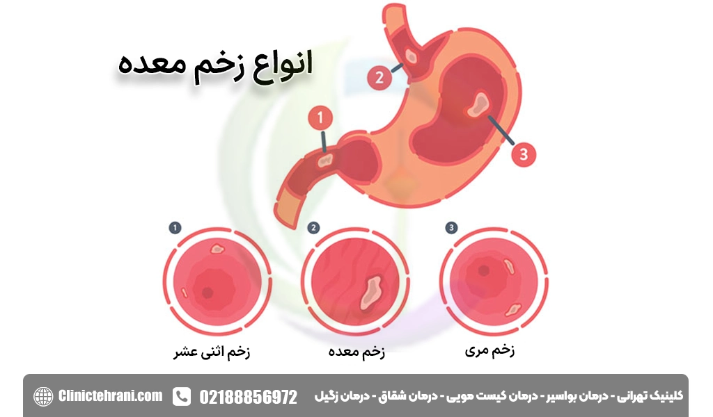 انواع زخم معده