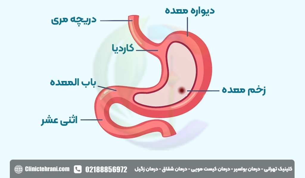 تشخیص زخم معده
