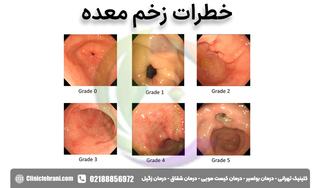 خطرات زخم معده