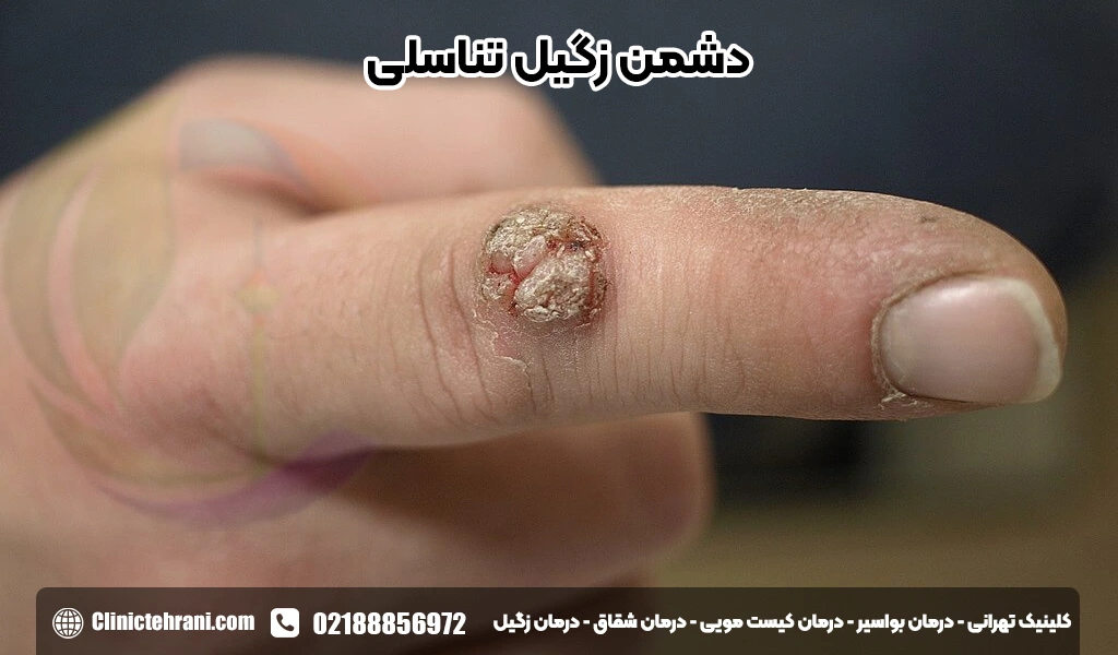 دشمن زگیل تناسلی