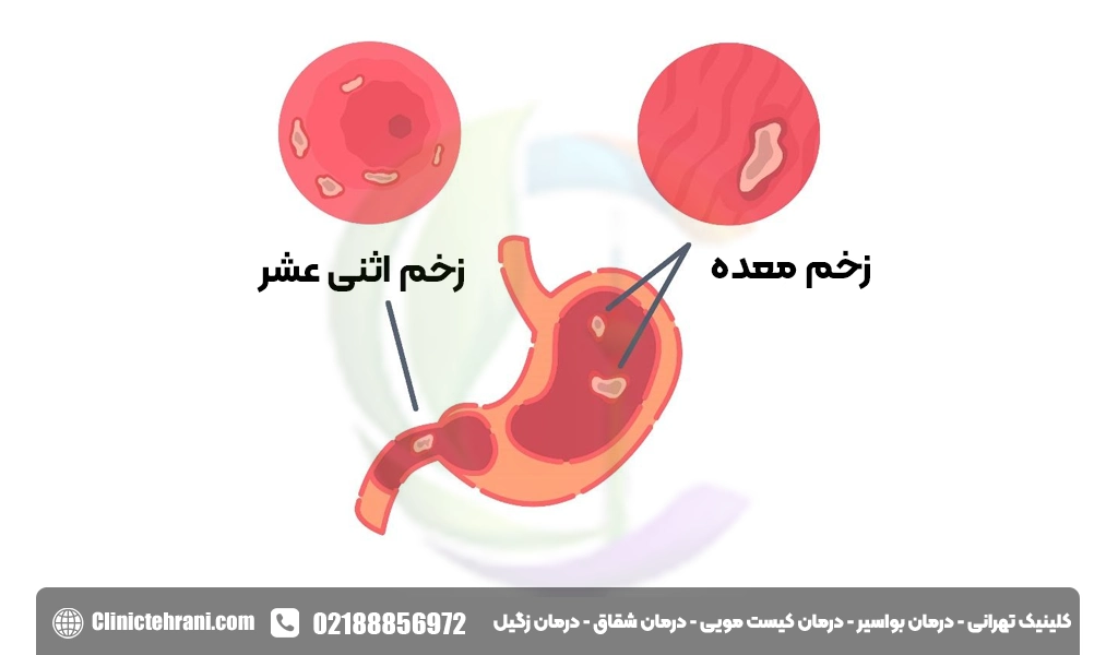 علائم زخم معده