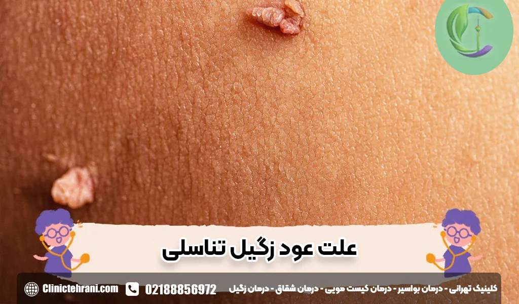 علت عود زگیل تناسلی