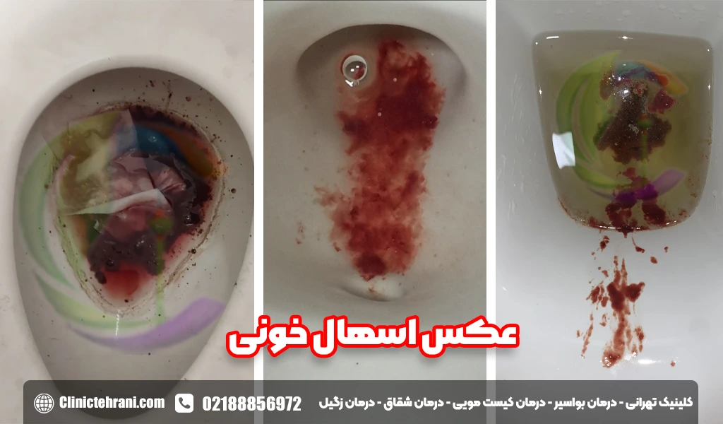 عکس اسهال خونی