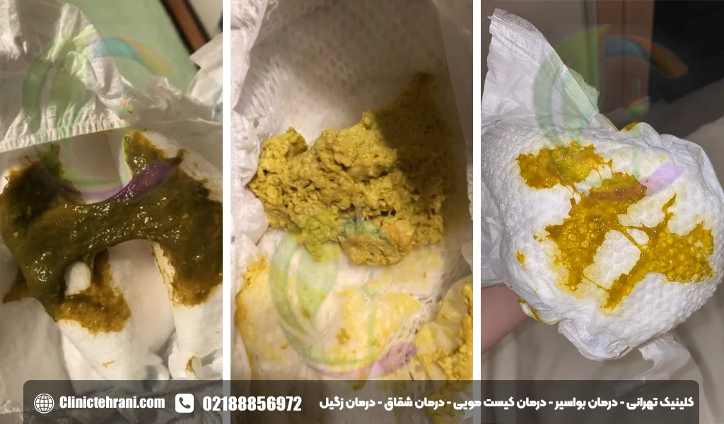 عکس مدفوع چسبناک