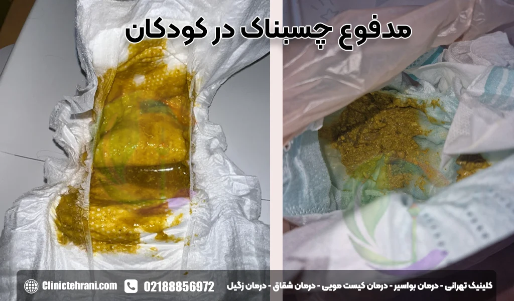 مدفوع چسبناک در کودکان