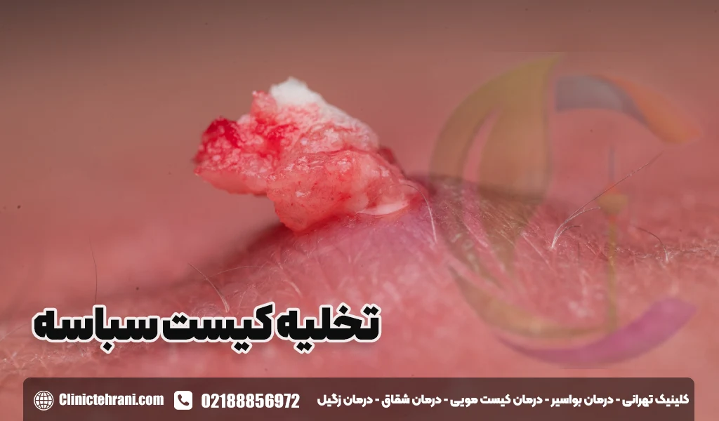تخلیه کیست سباسه