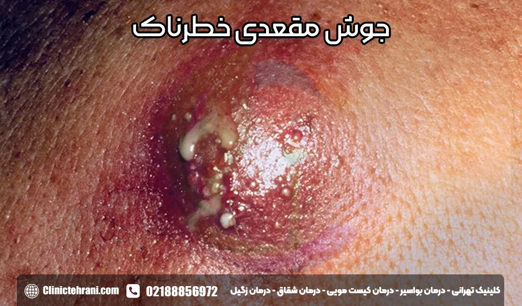 جوش مقعدی خطرناک