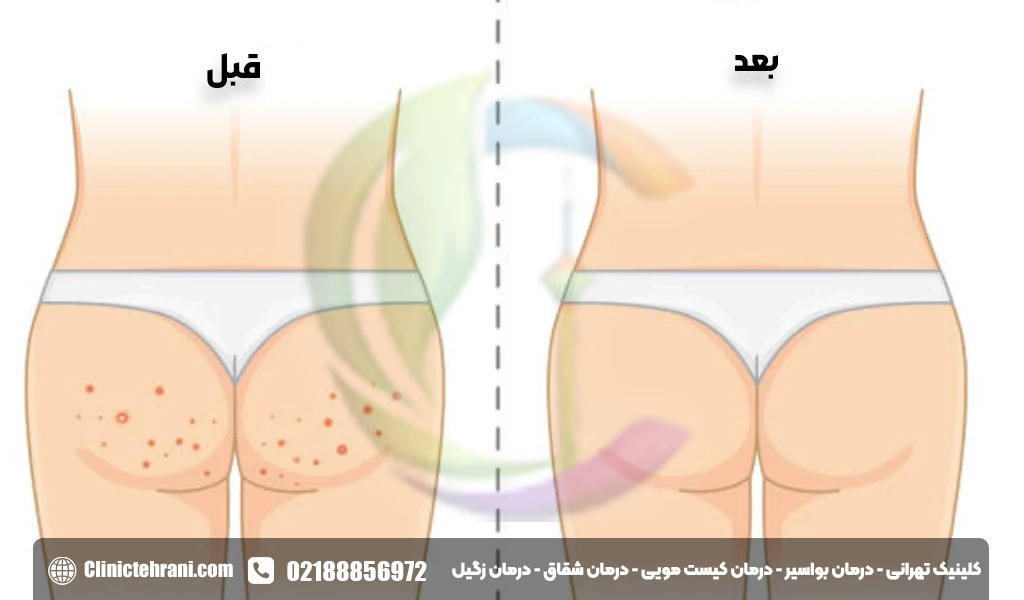 خطرات و عوارض جوش مقعد