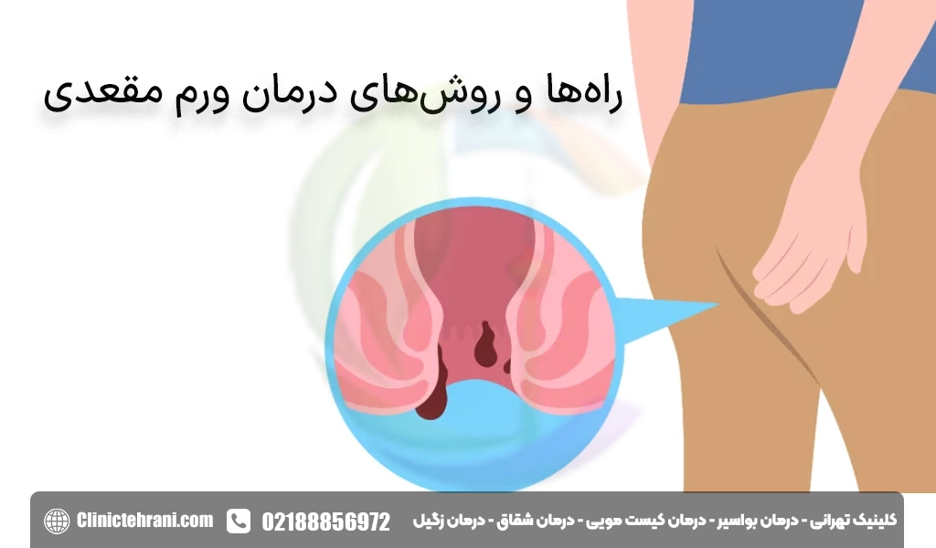 درمان ورم مقعدی