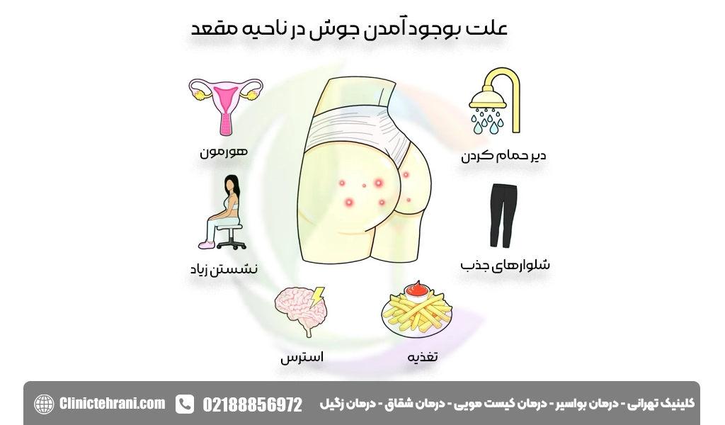 علت بوجود آمدن جوش در ناحیه مقعد