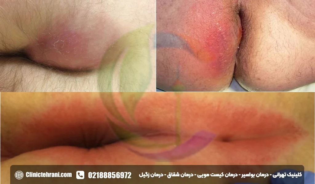 عکس ورم مقعدی