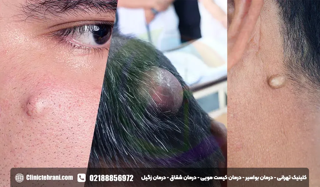 غدد سباسه