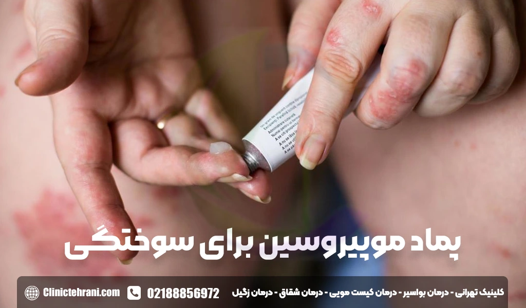 پماد موپیروسین برای سوختگی