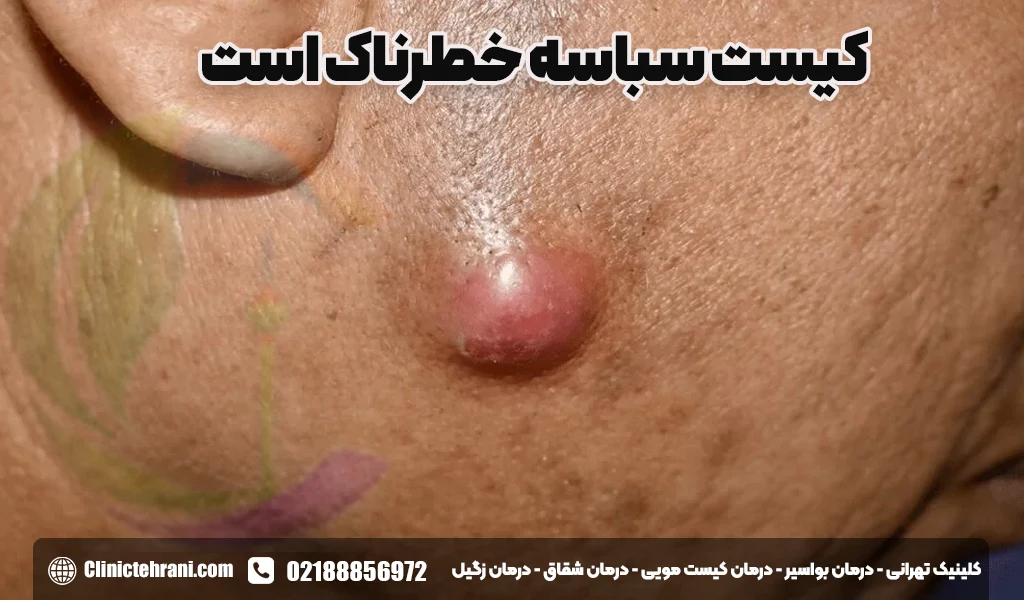 کیست سباسه خطرناک است