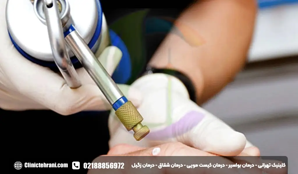کرایوتراپی زگیل تناسلی
