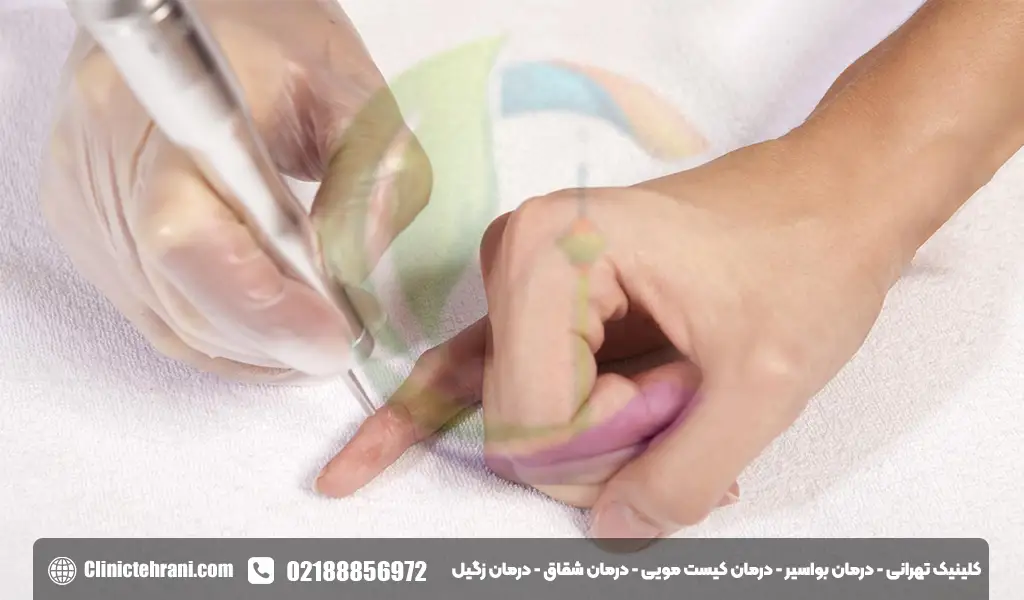 استفاده از لیزر برای زگیل تناسلی