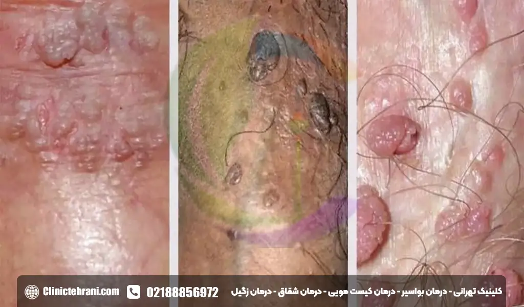 درمان صد در صد زگیل تناسلی