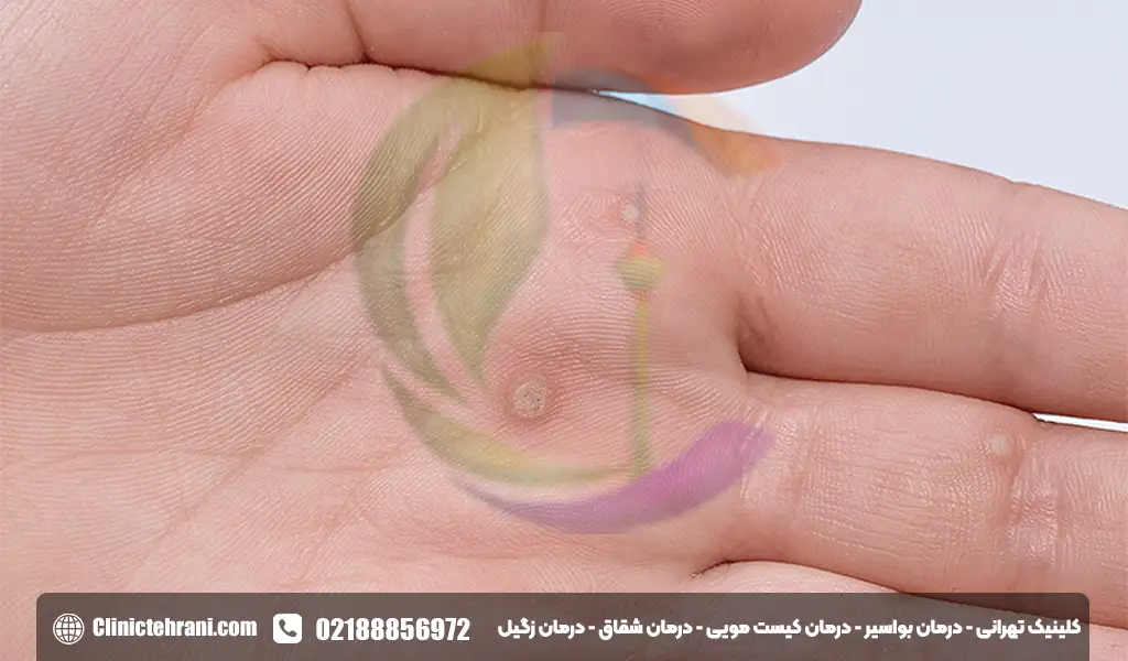 شکل اولیه زگیل تناسلی